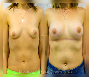 увеличение груди, результат №449, предварительное изображение до и после операции
