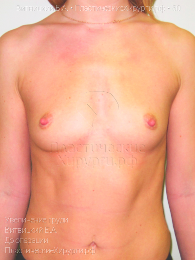 увеличение груди, пластический хирург Витвицкий Б. А., результат №60, ракурс 1, фото до операции