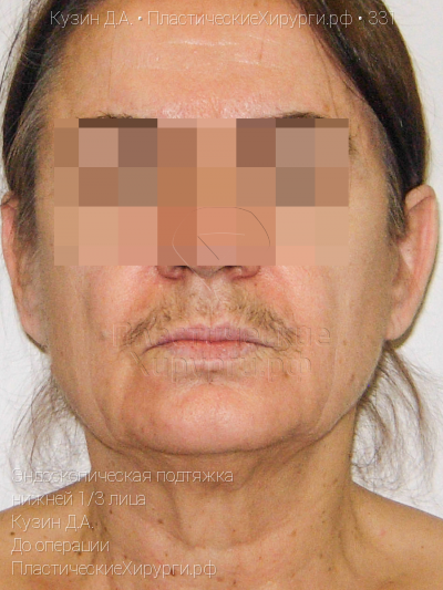 эндоскопическая подтяжка нижней трети лица, пластический хирург Кузин Д. А., результат №331, ракурс 1, фото до операции