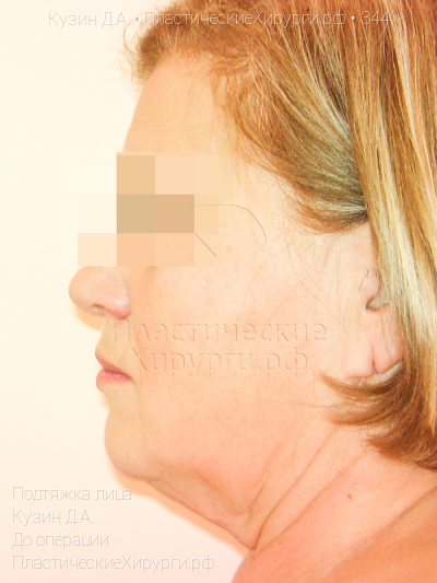 подтяжка лица, пластический хирург Кузин Д. А., результат №344, ракурс 3, фото до операции