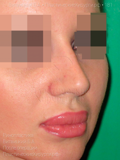 ринопластика, пластический хирург Витвицкий Б. А., результат №181, ракурс 2, фото после операции