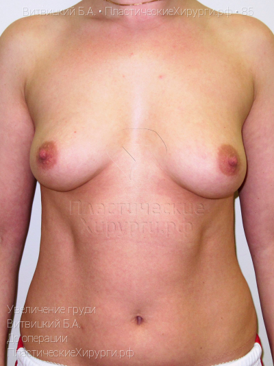 увеличение груди, пластический хирург Витвицкий Б. А., результат №85, ракурс 1, фото до операции