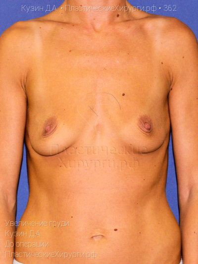 увеличение груди, пластический хирург Кузин Д. А., результат №362, ракурс 1, фото до операции