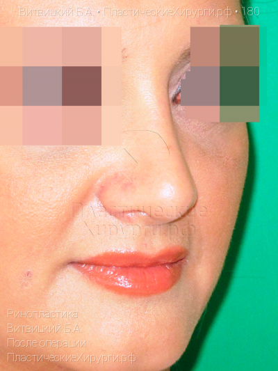 ринопластика, пластический хирург Витвицкий Б. А., результат №180, ракурс 2, фото после операции