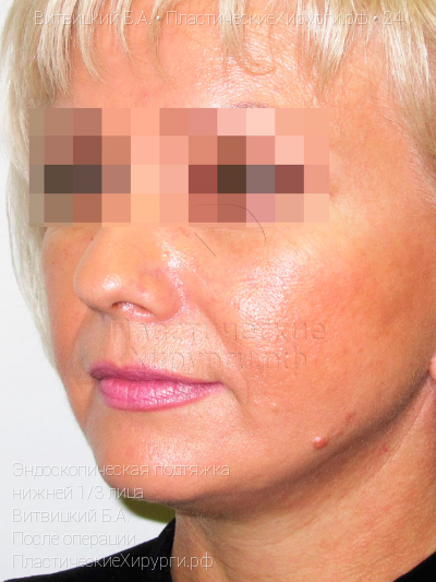 эндоскопическая подтяжка нижней трети лица, пластический хирург Витвицкий Б. А., результат №24, ракурс 2, фото после операции