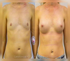 увеличение груди, результат №441, предварительное изображение до и после операции