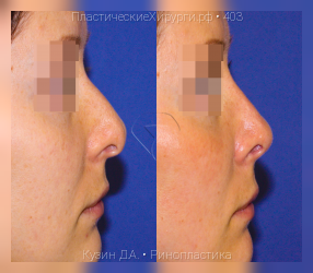ринопластика, результат №403, предварительное изображение до и после операции