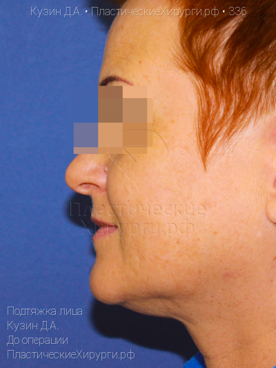 подтяжка лица, пластический хирург Кузин Д. А., результат №336, ракурс 3, фото до операции