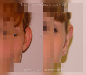 отопластика, результат №385, предварительное изображение до и после операции