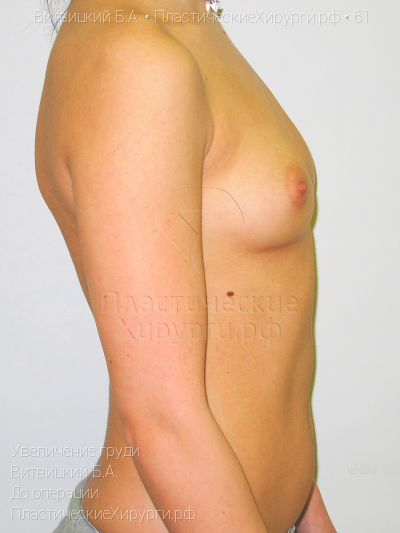 увеличение груди, пластический хирург Витвицкий Б. А., результат №61, ракурс 3, фото до операции