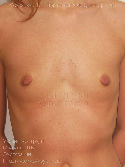 увеличение груди, пластический хирург Моураова Л. Б., результат №293, ракурс 1, фото до операции