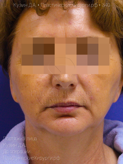 подтяжка лица, пластический хирург Кузин Д. А., результат №340, ракурс 1, фото до операции