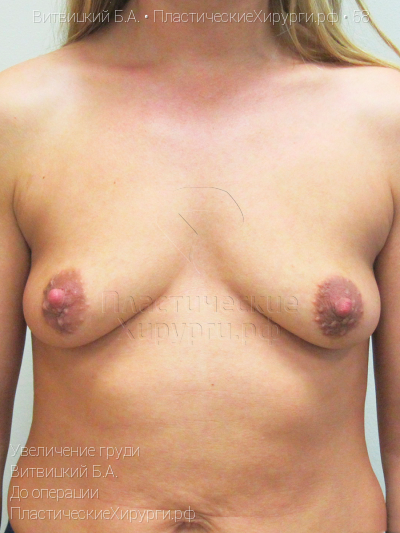 увеличение груди, пластический хирург Витвицкий Б. А., результат №58, ракурс 1, фото до операции