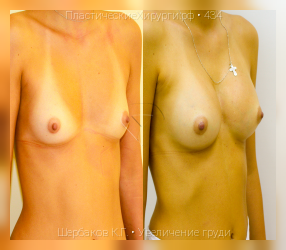 увеличение груди, результат №434, предварительное изображение до и после операции