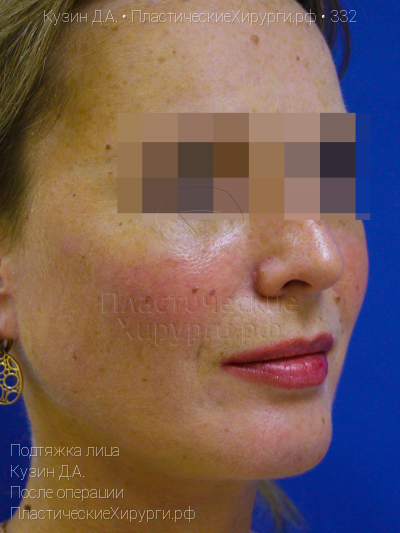 подтяжка лица, пластический хирург Кузин Д. А., результат №332, ракурс 2, фото после операции