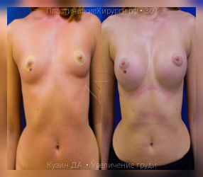 увеличение груди, результат №369, предварительное изображение до и после операции
