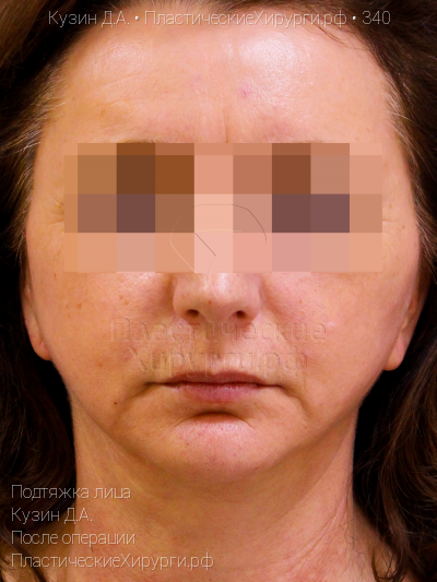 подтяжка лица, пластический хирург Кузин Д. А., результат №340, ракурс 1, фото после операции