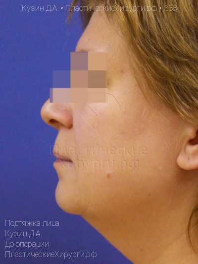 подтяжка лица, пластический хирург Кузин Д. А., результат №338, ракурс 2, фото до операции