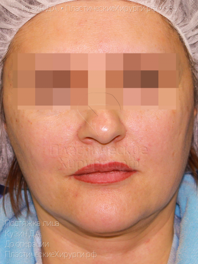 подтяжка лица, пластический хирург Кузин Д. А., результат №335, ракурс 1, фото до операции