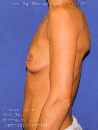 увеличение груди, пластический хирург Кузин Д. А., результат №362, ракурс 3, фото до операции