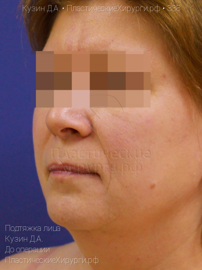подтяжка лица, пластический хирург Кузин Д. А., результат №338, ракурс 1, фото до операции