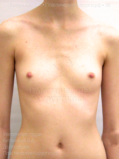 увеличение груди, пластический хирург Витвицкий Б. А., результат №38, ракурс 1, фото до операции