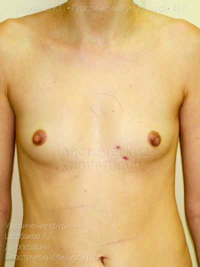 увеличение груди, пластический хирург Щербаков К. Г., результат №417, ракурс 1, фото до операции