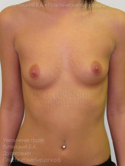увеличение груди, пластический хирург Витвицкий Б. А., результат №71, ракурс 1, фото до операции