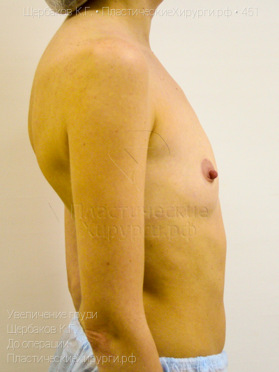 увеличение груди, пластический хирург Щербаков К. Г., результат №451, ракурс 3, фото до операции