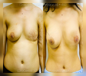 увеличение груди, результат №460, предварительное изображение до и после операции