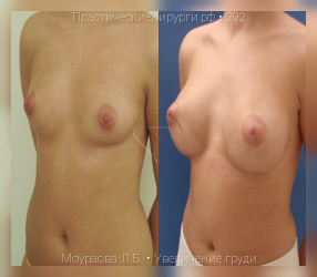 увеличение груди, результат №292, предварительное изображение до и после операции
