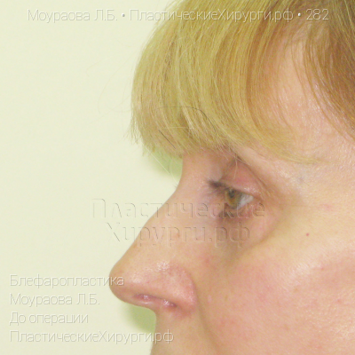 блефаропластика, пластический хирург Моураова Л. Б., результат №282, ракурс 3, фото до операции