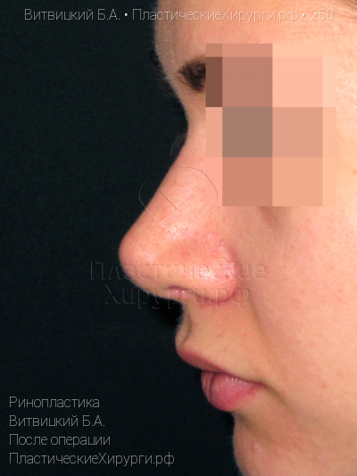 ринопластика, пластический хирург Витвицкий Б. А., результат №250, ракурс 5, фото после операции