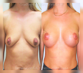 увеличение груди, результат №58, предварительное изображение до и после операции