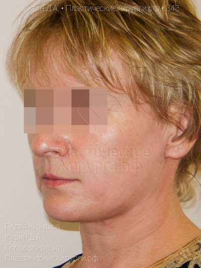 подтяжка лица, пластический хирург Кузин Д. А., результат №343, ракурс 2, фото после операции