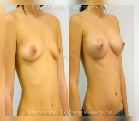 увеличение груди, результат №412, предварительное изображение до и после операции