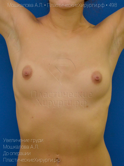 увеличение груди, пластический хирург Мошкалова А. Л., результат №498, ракурс 6, фото до операции
