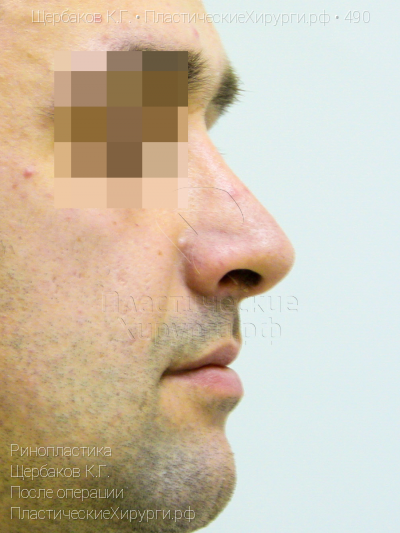 ринопластика, пластический хирург Щербаков К. Г., результат №490, ракурс 3, фото после операции