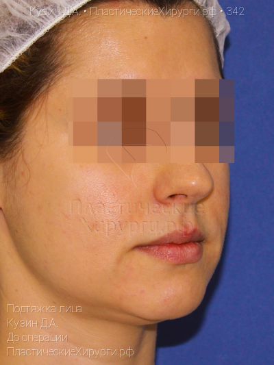 подтяжка лица, пластический хирург Кузин Д. А., результат №342, ракурс 2, фото до операции