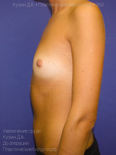 увеличение груди, пластический хирург Кузин Д. А., результат №360, ракурс 3, фото до операции