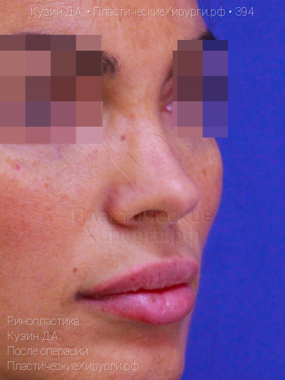 ринопластика, пластический хирург Кузин Д. А., результат №394, ракурс 2, фото после операции