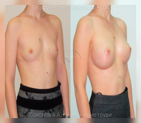 увеличение груди, результат №508, предварительное изображение до и после операции