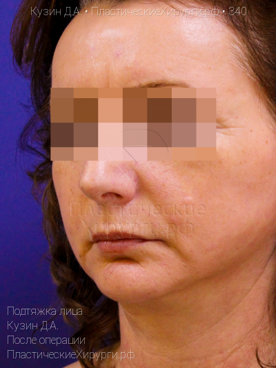 подтяжка лица, пластический хирург Кузин Д. А., результат №340, ракурс 2, фото после операции