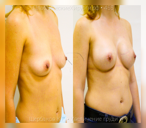 увеличение груди, результат №455, предварительное изображение до и после операции