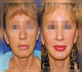 подтяжка лица, результат №337, предварительное изображение до и после операции