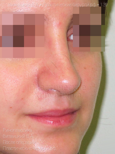 ринопластика, пластический хирург Витвицкий Б. А., результат №139, ракурс 2, фото после операции
