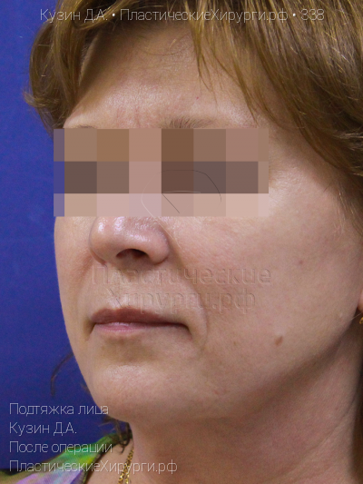 подтяжка лица, пластический хирург Кузин Д. А., результат №338, ракурс 1, фото после операции