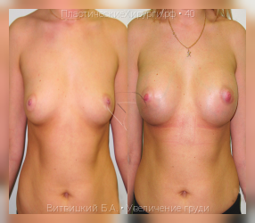 увеличение груди, результат №40, предварительное изображение до и после операции
