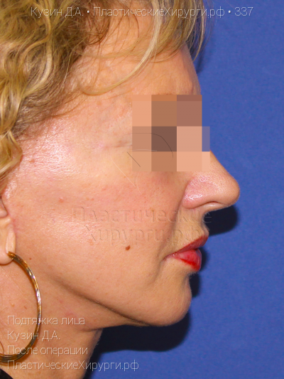 подтяжка лица, пластический хирург Кузин Д. А., результат №337, ракурс 3, фото после операции