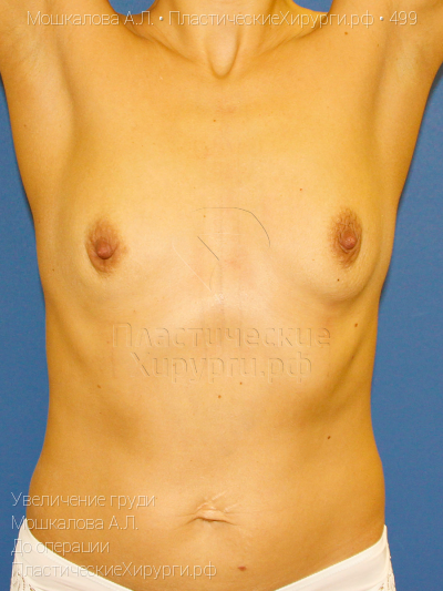 увеличение груди, пластический хирург Мошкалова А. Л., результат №499, ракурс 6, фото до операции